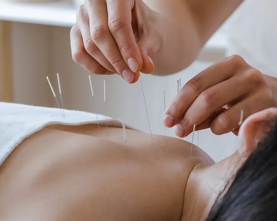 Sesión de acupuntura, medicina alternativa en Guadalupe Plus, Pereira
